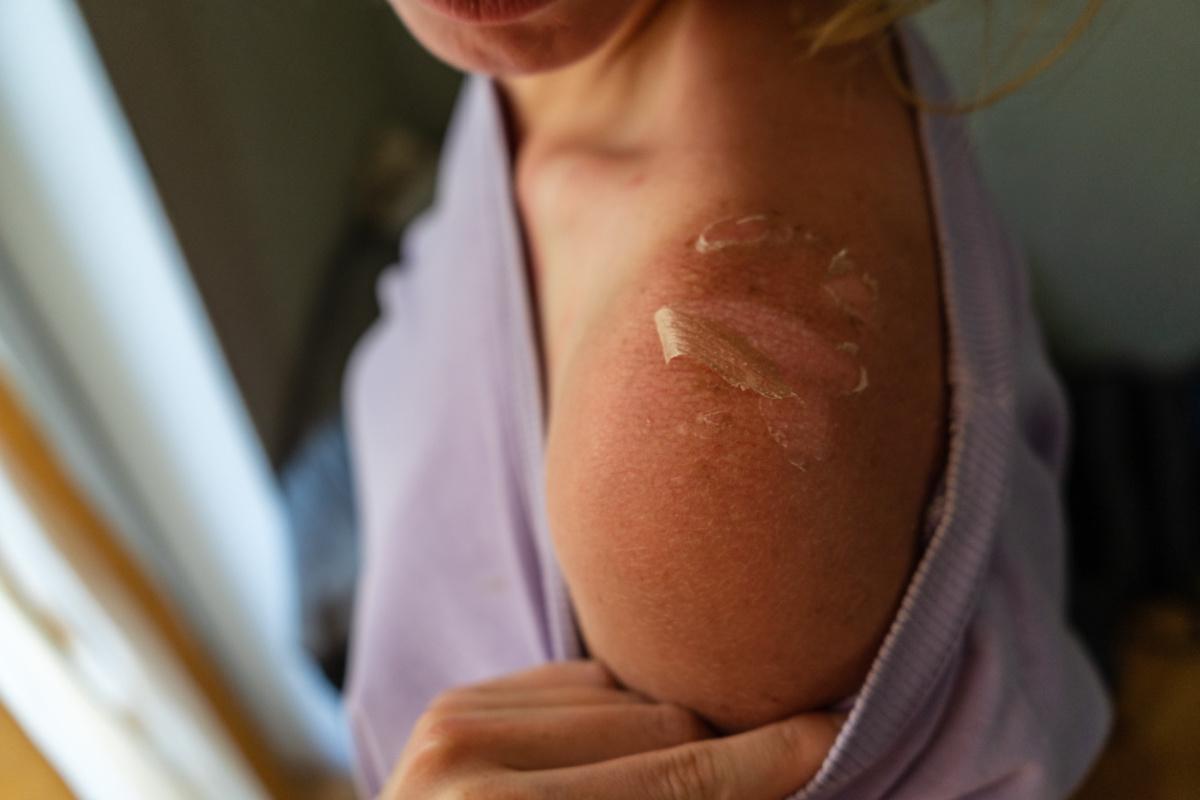 Dermatite solare e carcinoma squamocellulare 